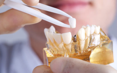 Dentist Explains How Dental Implants in Lancaster, PA Work